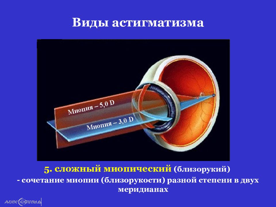 Миопия астигматизм глаз. Миопический астигматизм классификация. Миопический роговичный астигматизм. Астигматизм клинические проявления. Сложный миопический астигматизм обоих глаз.