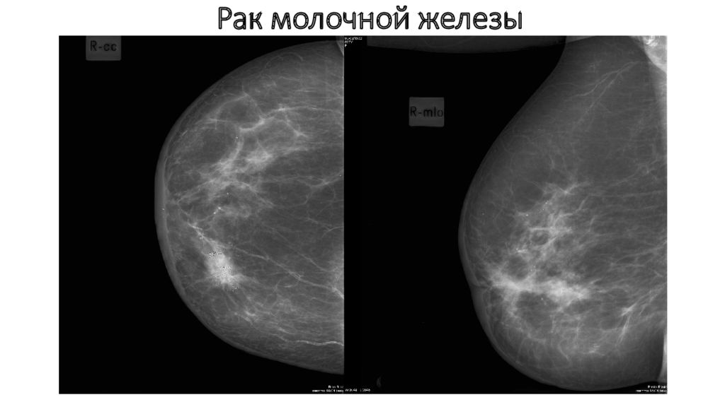 Шишка в грудной железе у женщин. Диффузный фиброаденоматоз. Опухоль молочной железы маммограмма. Рик молочной железы маммографич. Диф фиброаденоматоз молочных желез.