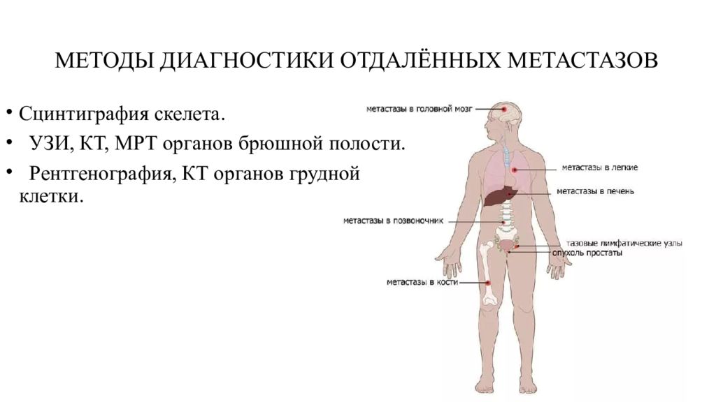 Отдаленные метастазы при раке. Методы диагностики метастазов. Метастазы в кости у мужчин. Метастазы предстательной железы.