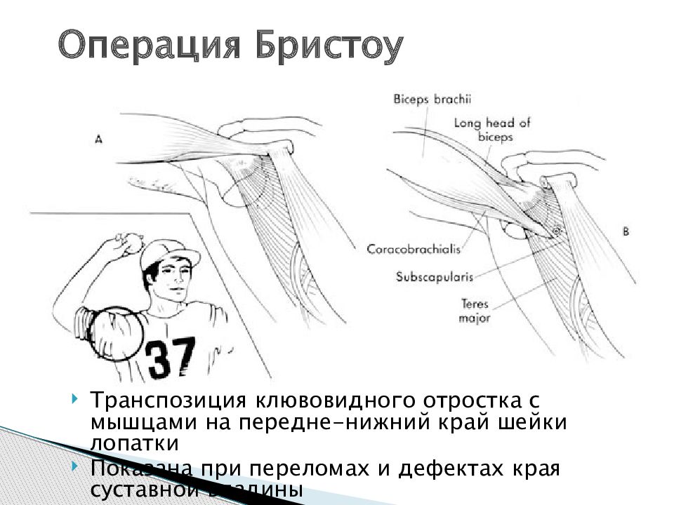 Вывихи плечевого сустава презентация