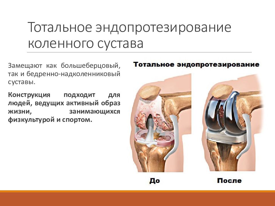 Операция по замене сустава на ноге. Тотальное эндопротезирование коленного сустава DEPUY. Тотальное эндопротезирование коленного сустава цементная фиксация. Тотальное эндопротезирование тазобедренного сустава. Эндопротезирование тазобедренного сустава тотальное (схема 2).