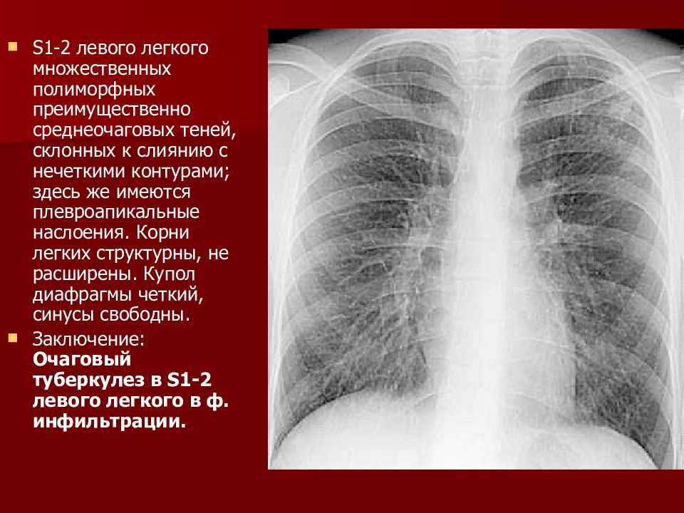 Легочный рисунок усилен перибронхиальным компонентом