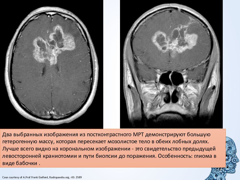 Рак головного мозга презентация