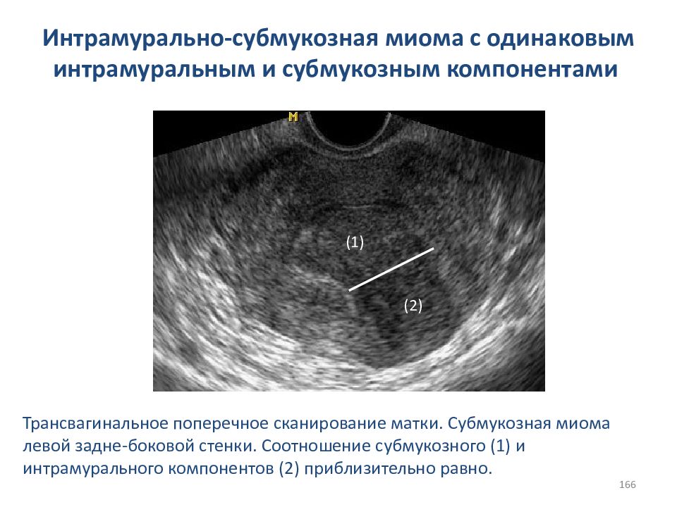 Интрамуральная лейомиома матки что это означает. Миома матки УЗИ субмукозный. Интрамуральная субмукозная миома. Субмукозная шеечная миома.