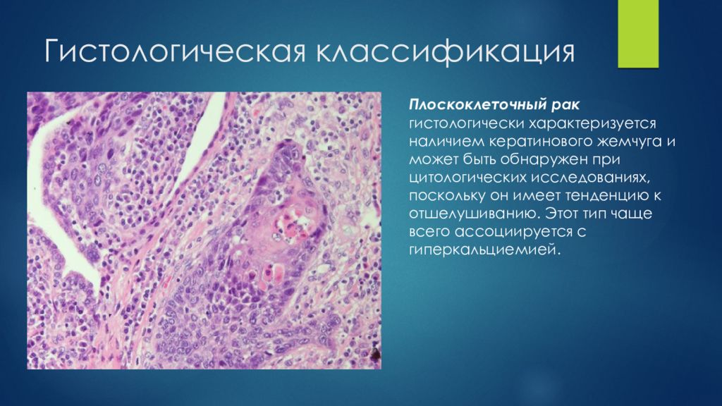 Стадии рака легких плоскоклеточный. Плоскоклеточная карцинома легкого микропрепарат. Плоскоклкточный раклегкого гистология. Плоскоклеточная карцинома легкого гистология. Нейроэндокринная карцинома печени гистология.