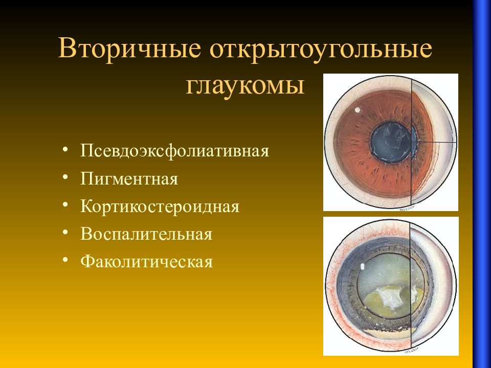 Открытоугольная глаукома картинки