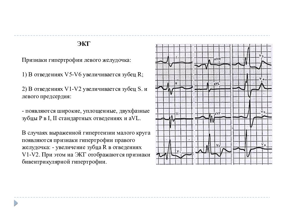 Гипертрофия лев желудочка экг. ЭКГ синдром гипертрофии желудочков. ЭКГ при гипертрофии левого правого желудочка. ЭКГ при гипертрофии левого желудочка. Гипертрофия лж на ЭКГ.