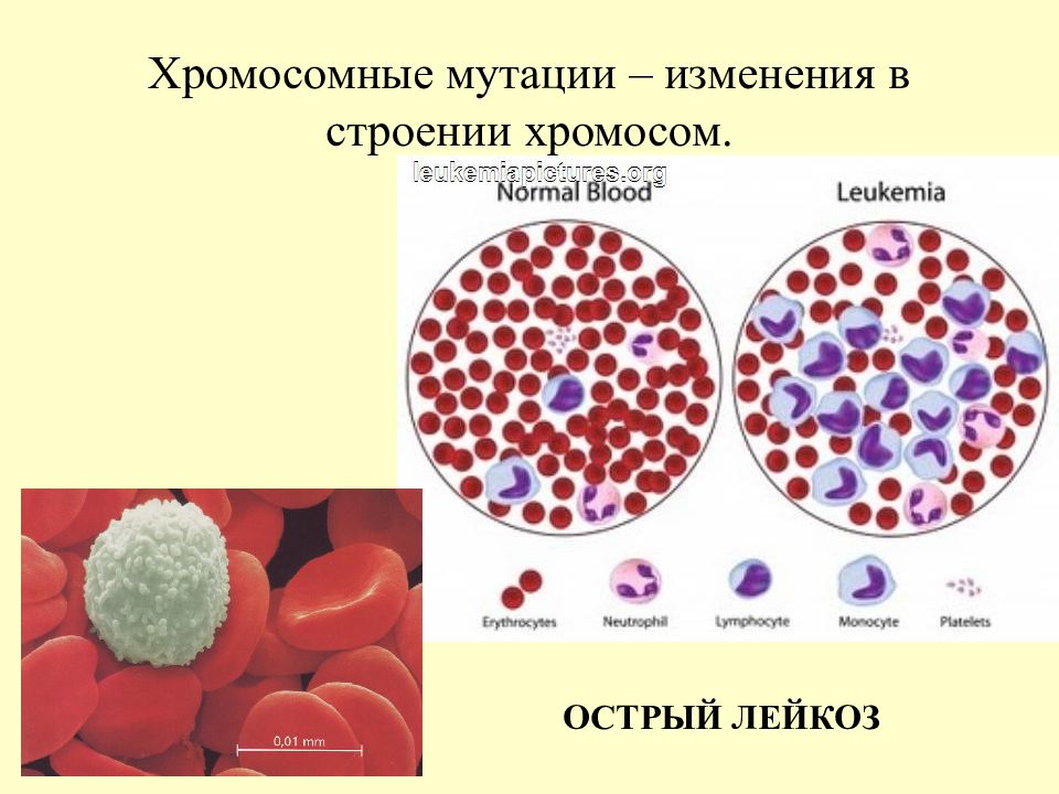 Мутации связанные с хромосомами. Миелоидный лейкоз хромосомная мутация. Лейкемия хромосомная мутация.