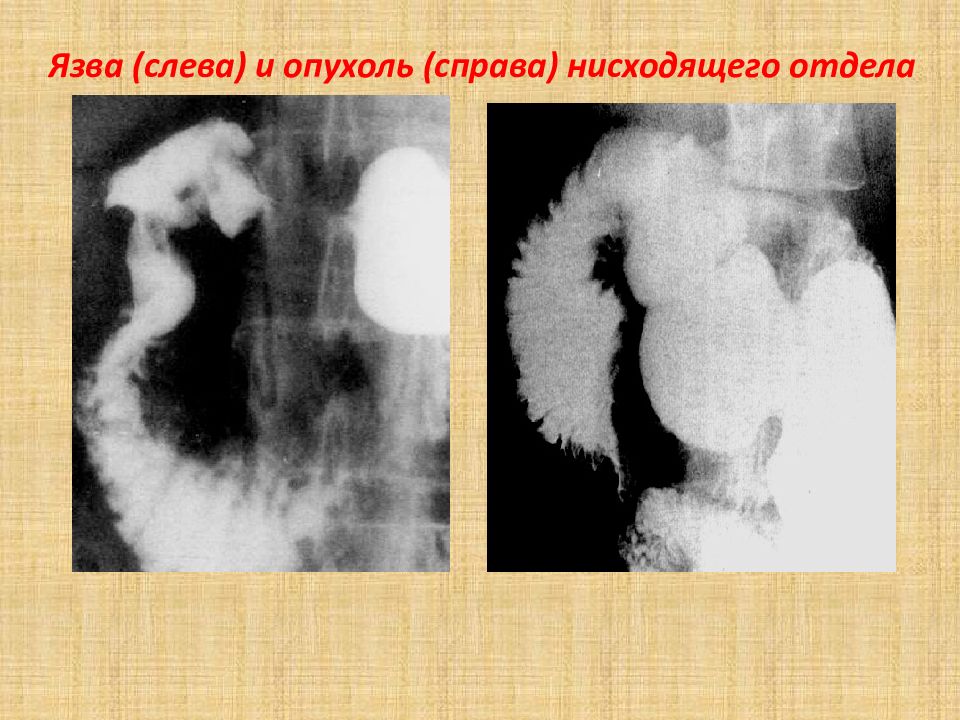 Опухоль левой. Опухоль нисходящая что это такое. Опухоль на правой стороне. Глиома справа а очаг эпиактивности слева.