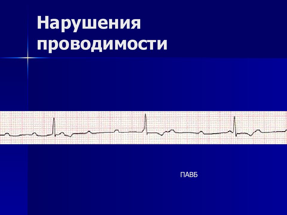 Нарушение проводимости. Нарушение проводимости у детей. Нарушение проводимости Calkala.