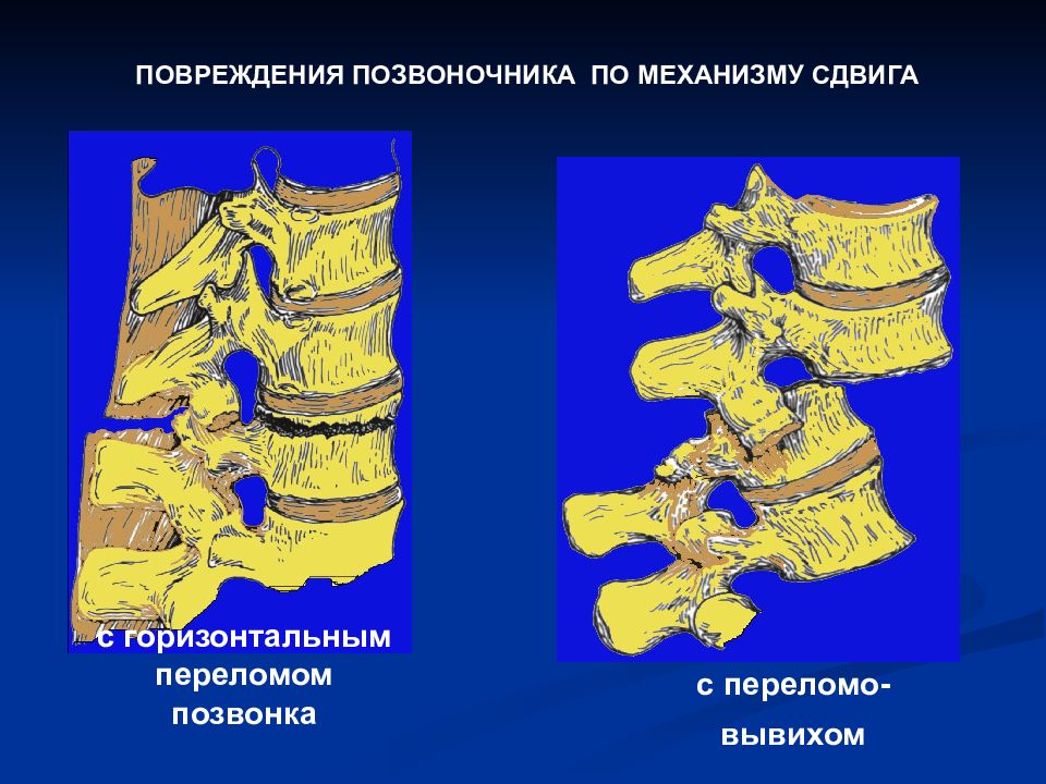 Презентация на тему повреждения позвоночника