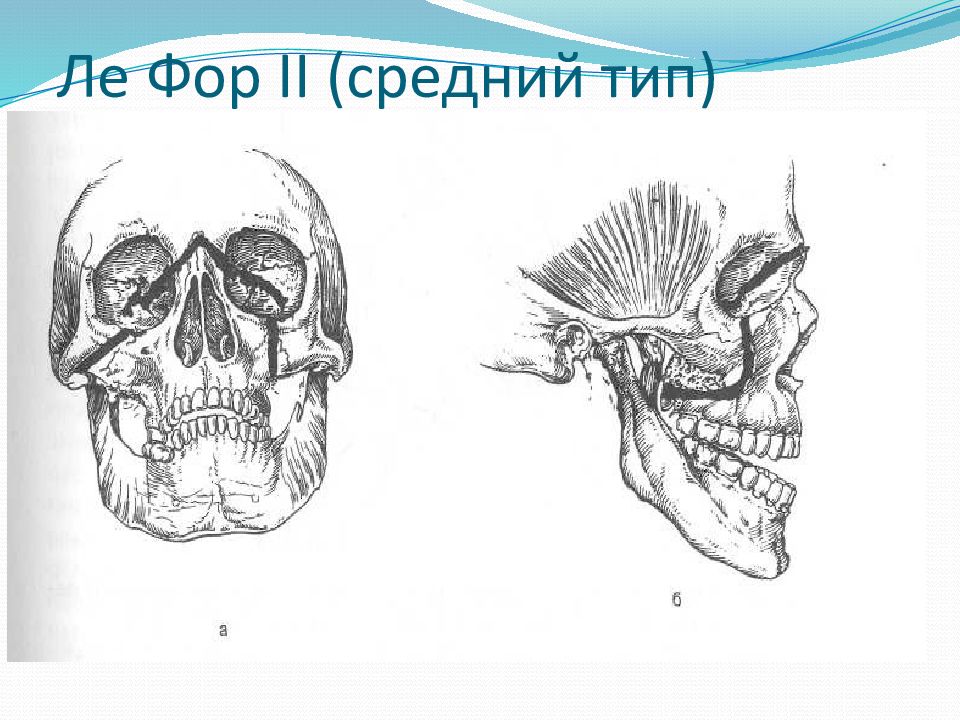 Перелом верхней челюсти презентация