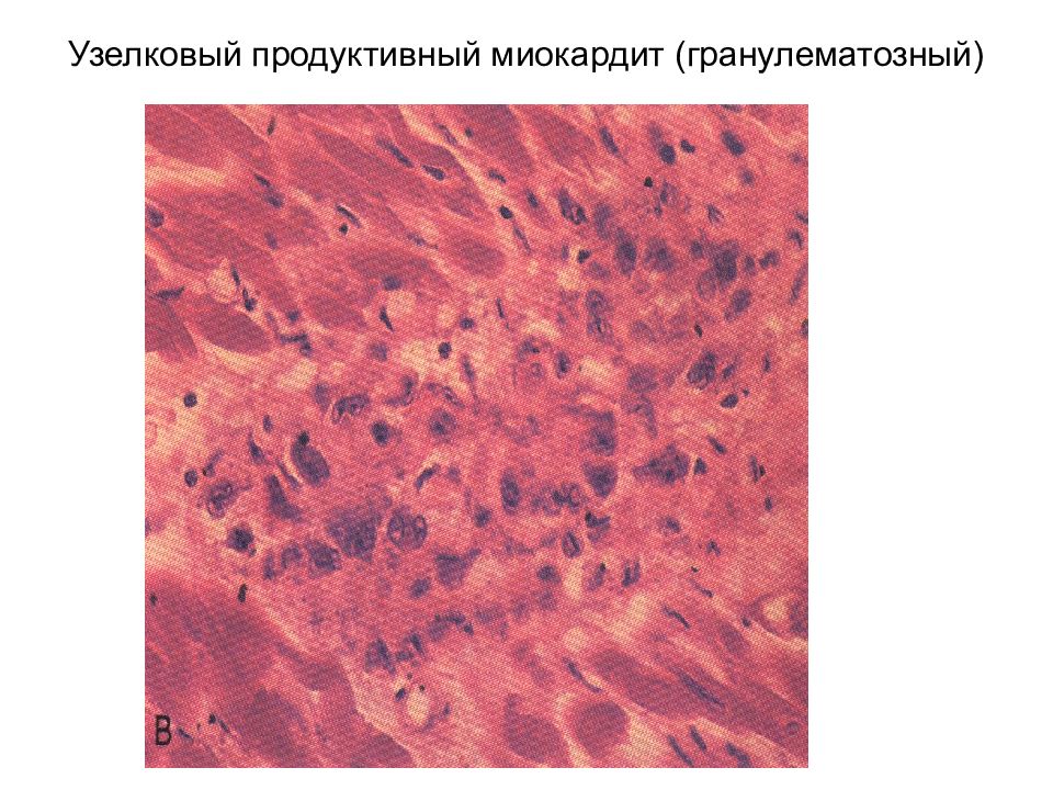 Ревматический миокардит микропрепарат рисунок