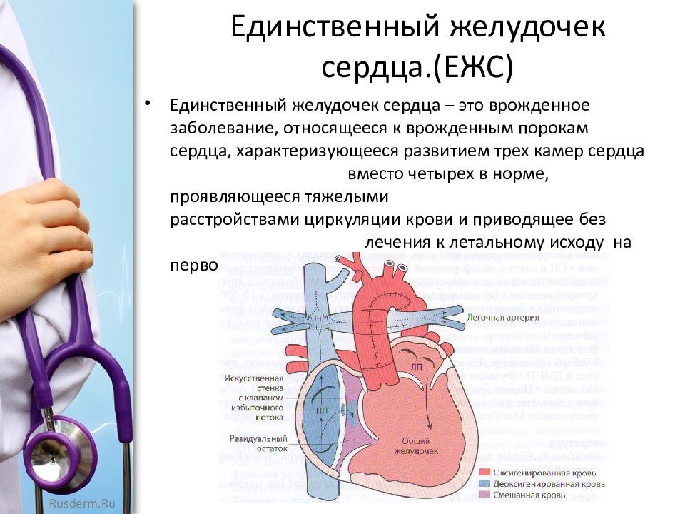 Сколько весит искусственный левый желудочек. Единственный желудочек сердца. Двуприточный единственный желудочек сердца. Единственный левый желудочек сердца. Единственный правый желудочек сердца.