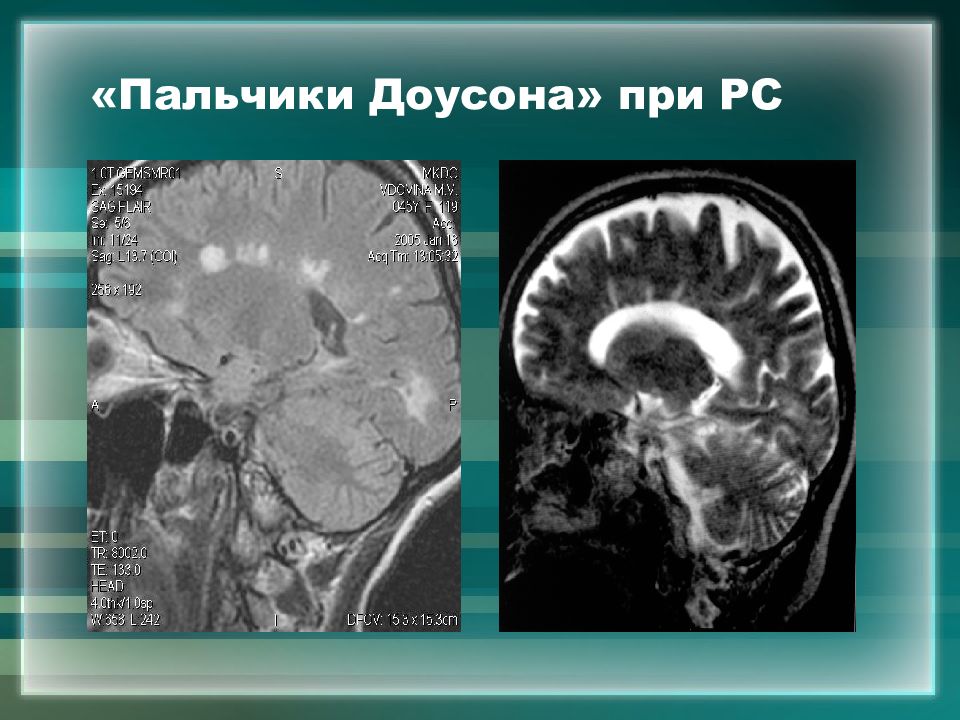 Презентация атрофия и склероз