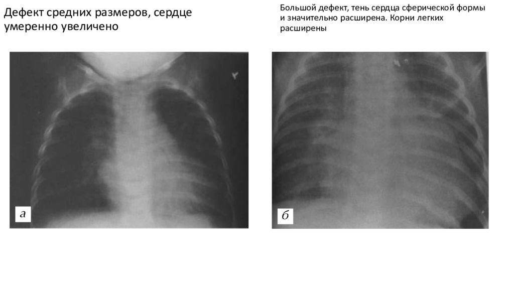 Незначительный увеличение сердца. Разрыв межжелудочковой перегородки дифференциальный диагноз. S образная межжелудочковая перегородка. Сердечный горб при дефекте межжелудочковой перегородки фото.