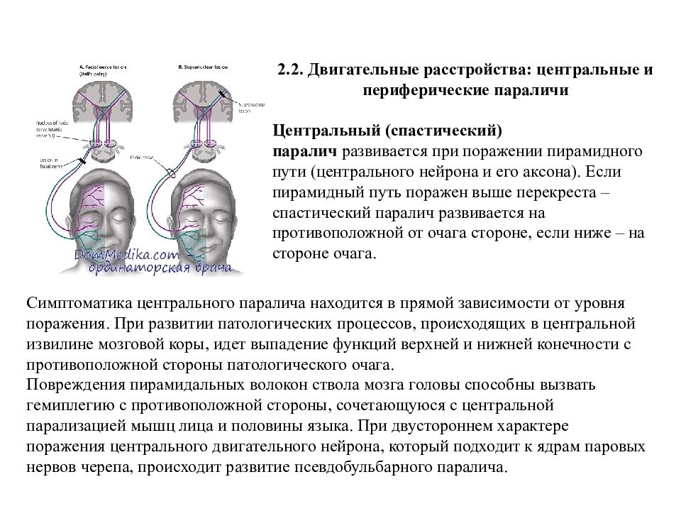 Центральный и периферический паралич презентация