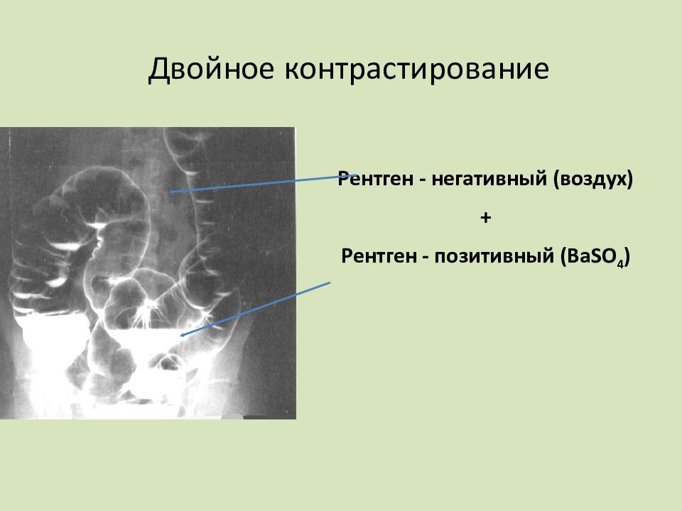 Функциональный рентген. Рентген двойное контрастирование. Рентген контрастирование. Методика двойного контрастирования. Методика двойного контрастирования желудка.