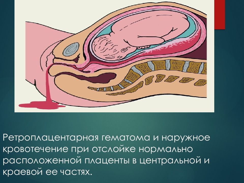 Отслойка при беременности. Преждевременная отслойка плаценты. Преждевременная отслойка нормально расположенной плаценты (ПОНРП). Краевой синус плаценты.