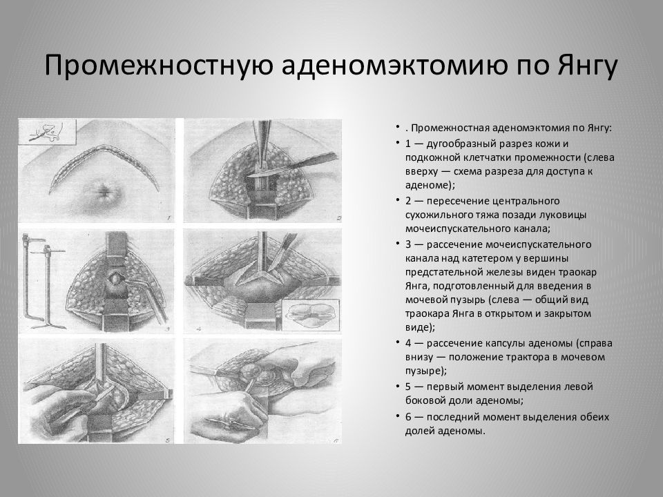 Удалена предстательная железа. Операция на предстательной железе. Резекция предстательной железы. Операция при аденоме предстательной железы. Аденома предстательной железы презентация.