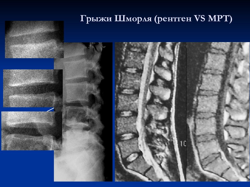 Грыжа шморля что это. Грыжа Шморля рентген. Грыжа Шморля на кт. Грыжа Шморля грудного отдела позвоночника рентген.