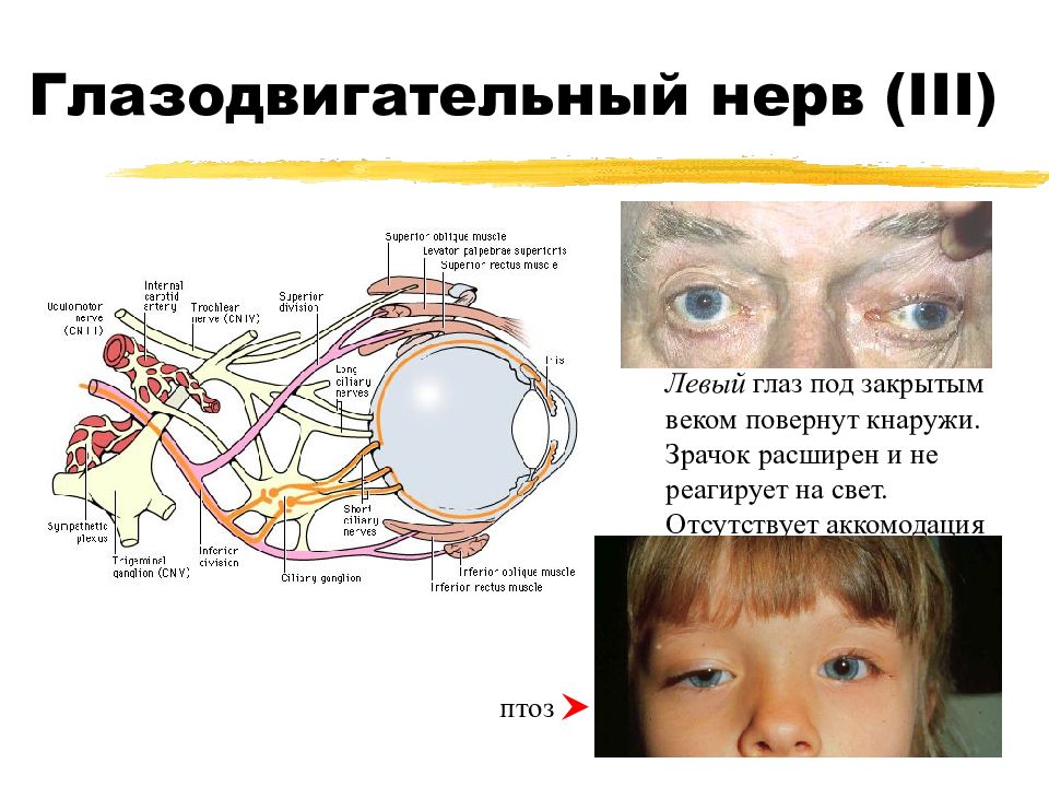 Глазодвигательный нерв мышцы. Топография ядер глазодвигательного нерва. Глазодвигательные нервы ( III , IV , vi). Глазодвигательный нерв (III). Ход глазодвигательного нерва схема.