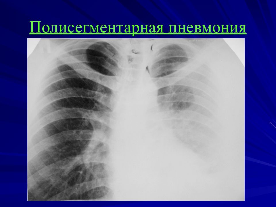 Двусторонняя пневмония. Левосторонняя полисегментарная пневмония рентген. Правосторонняя полисегментарная пневмония рентген. Внебольничная полисегментарная пневмония рентген. Левосторонняя полисегментарная плевропневмония рентген.