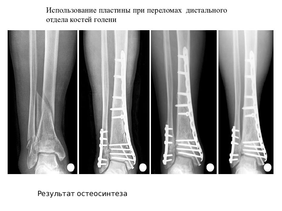 Переломы голени презентация