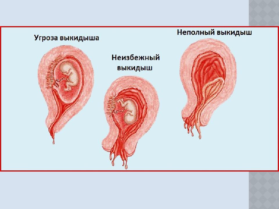 Привычный выкидыш презентация