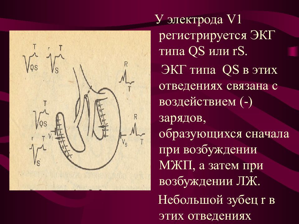 Типы электрокардиографов. QS Тип ЭКГ. Возбуждение межжелудочковой перегородки на ЭКГ. Типы электродов для ЭКГ.