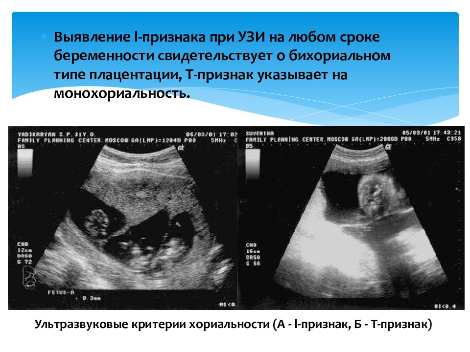 Беременность маловодие