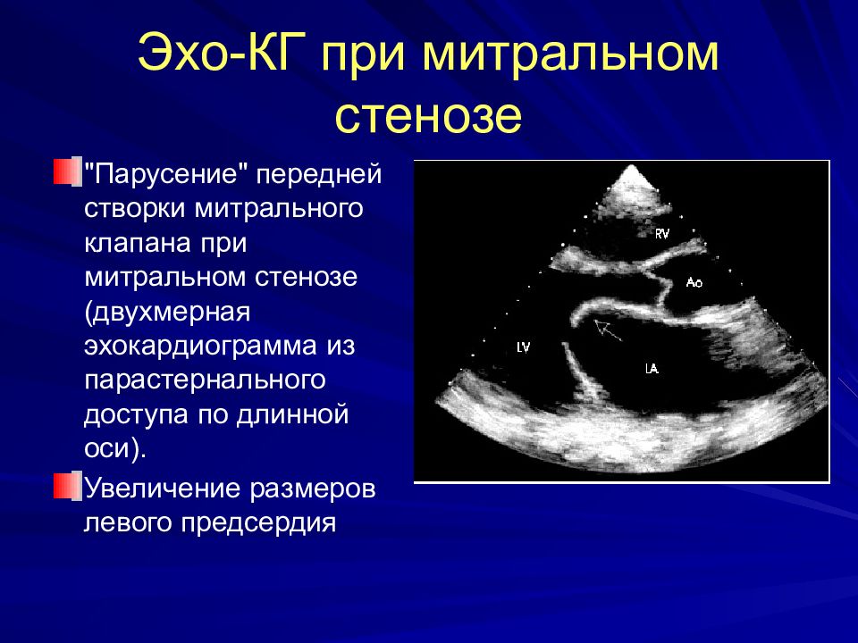 Что такое эхо. Аортальный стеноз эхокардиография. Эхокардиограмма митральный стеноз. Митральный стеноз по ЭХОКГ. Эхокардиографический признак митрального стеноза.