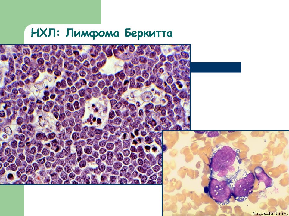 Лимфома беркитта. Лимфосаркома Беркитта. Лимфома Беркитта патанатомия. Лимфома Беркитта гистология. Лимфома Беркитта микропрепарат.
