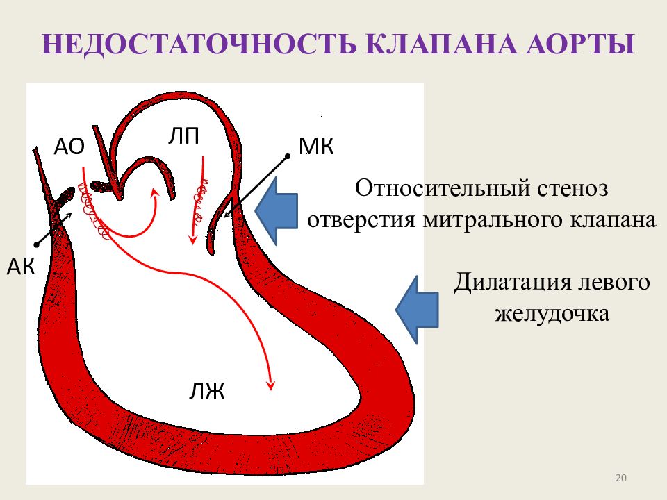 Аортальная сердечная недостаточность. Аортальный стеноз гемодинамика. Недостаточность аортального клапана гемодинамика схема. Недостаточность аортального клапана патогенез схема. Аортальный стеноз схема.