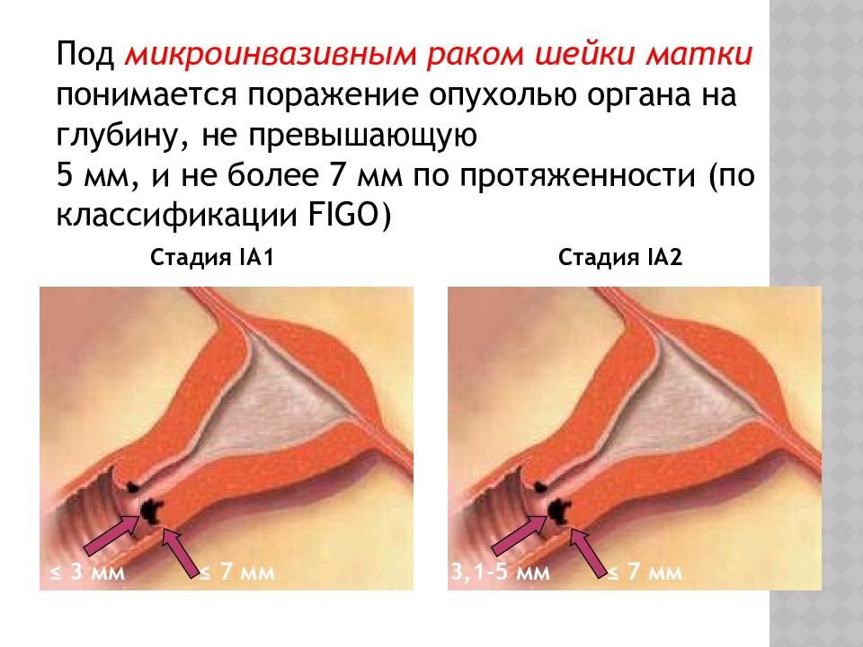 Что такое хронический цервицит шейки матки и как его лечить
