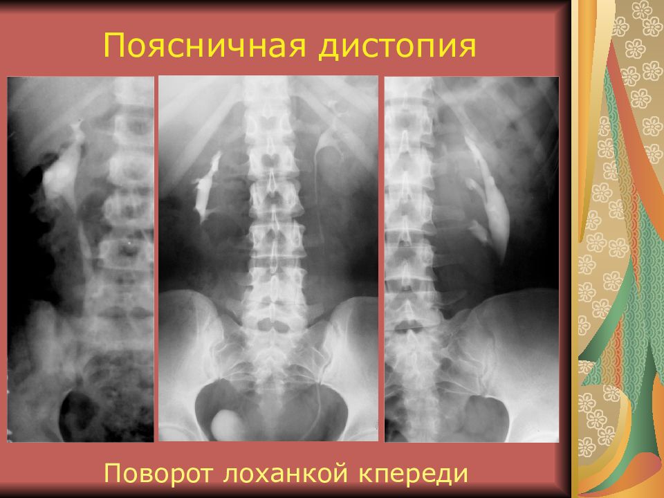 Дистопия почки. Тазовая дистопия почки рентген. Подвздошная дистопия почки рентген. Дистопия почки рентген. Торакальная дистопия почки.