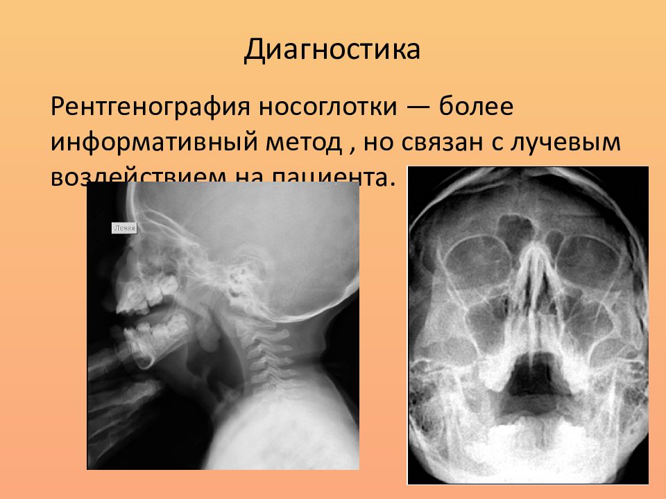 Аденоидные вегетации 3. Рентгенография носоглотки. Рентгенография ротоглотки.