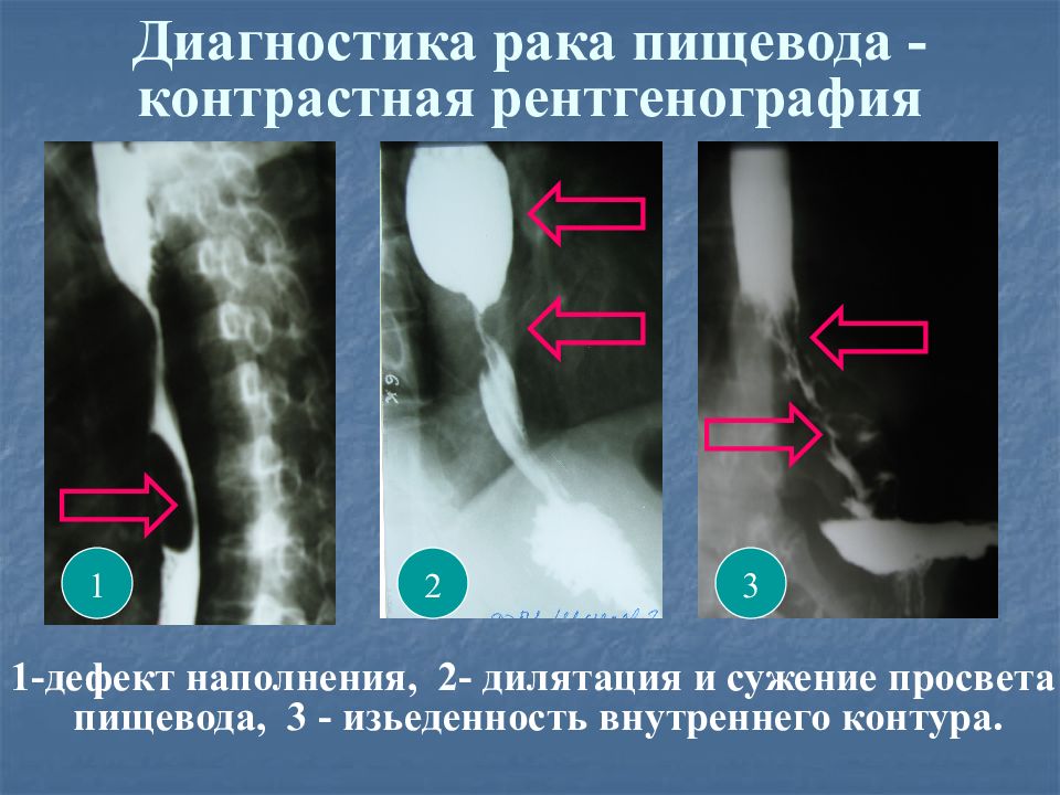 Синдром клешни презентация