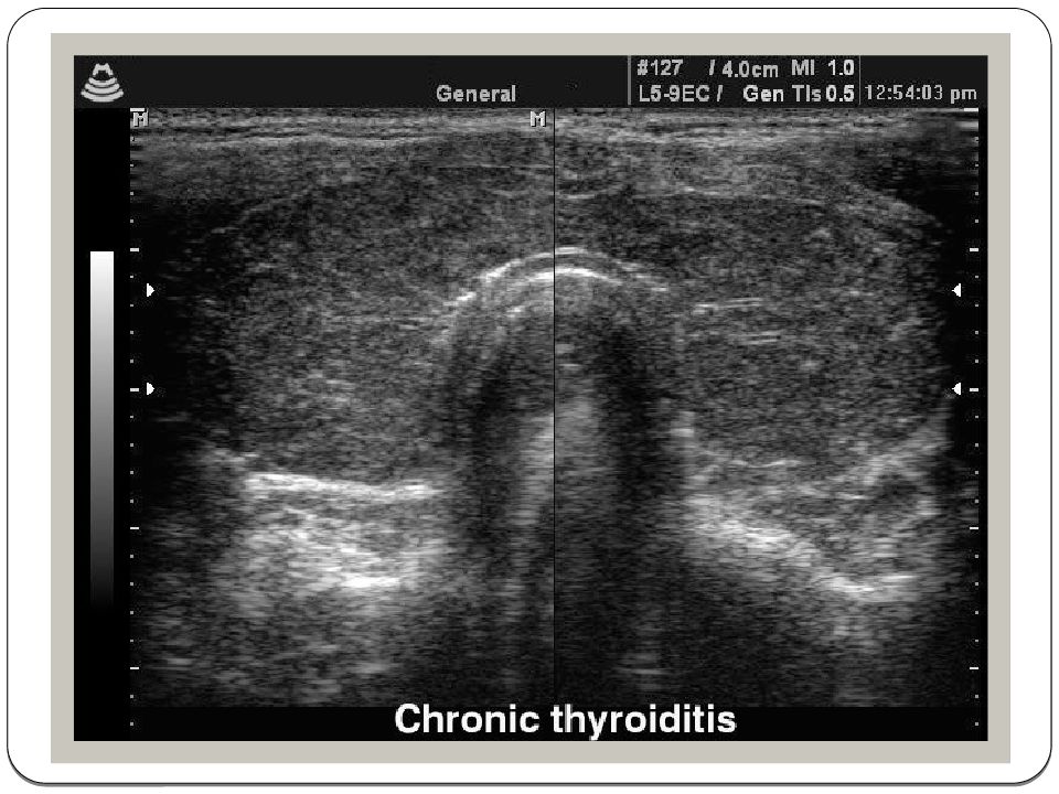Слабый диффузный. Хронический тиреоидит на УЗИ. ДТЗ на УЗИ щитовидной железы. Тиреоидит Риделя УЗИ картина.