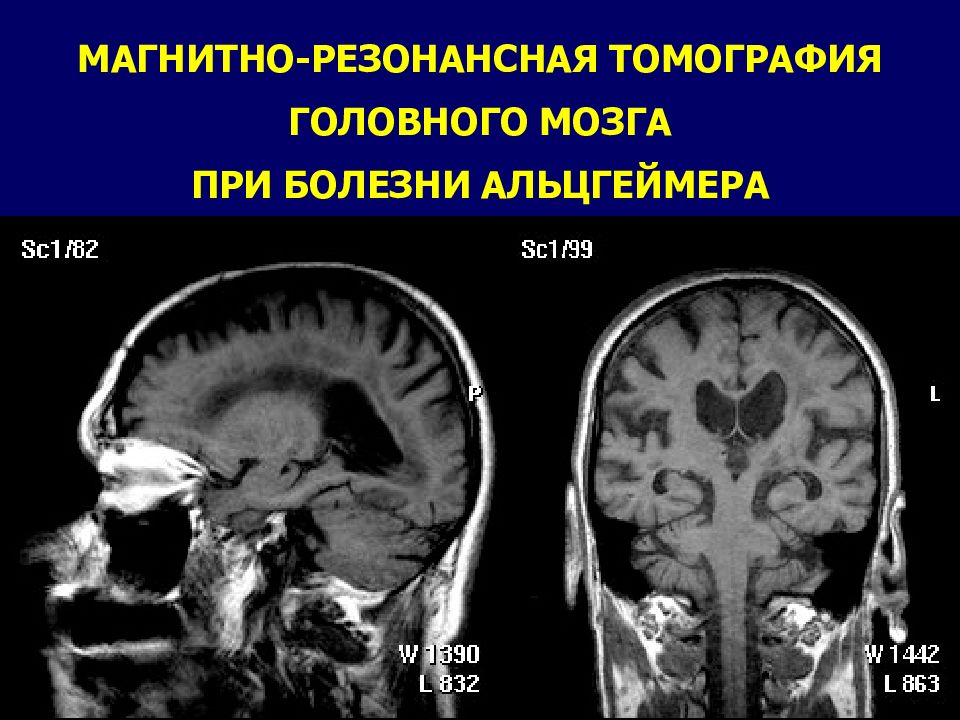 Картина дисциркуляторной энцефалопатии что это