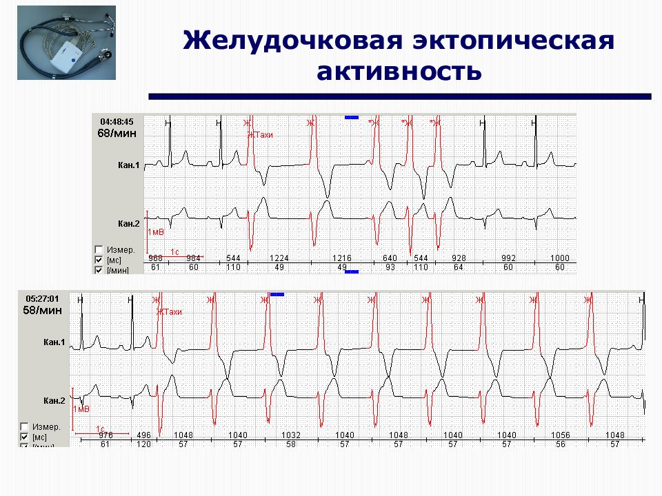 Экг спб. Схема холтера ЭКГ. Холтер ЭКГ схема. Монитор холтера отведения схема. Схема холтеровский монитора ЭКГ.