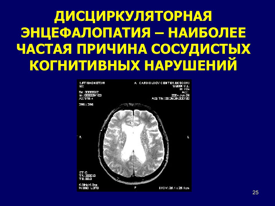 Картина очаговых изменений вещества мозга дисциркуляторного характера и постишемического характера