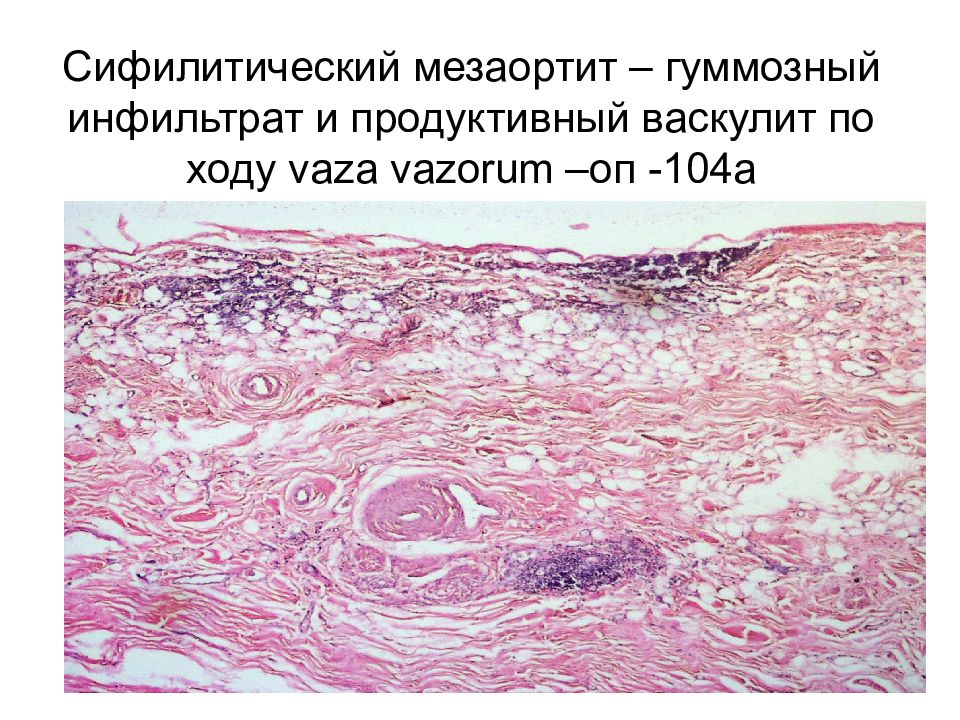 Воспаление патанатомия презентация