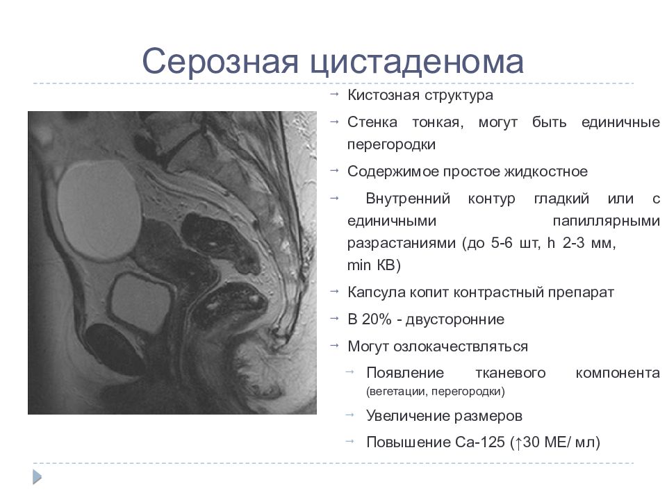 Цистаденома яичника на узи. Цистаденофиброма яичника гистология. Скюерозная цист аденома. Гладкостенная серозная цистаденома.