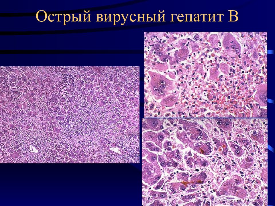 Абсцесс печени микропрепарат рисунок