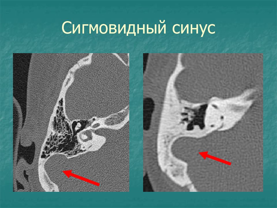 Кт височной кости москва. Кт анатомия сосцевидного отростка. Сосцевидный отросток височной кости кт. Сосцевидный отросток на кт. Сигмовидный синус на кт височных костей.