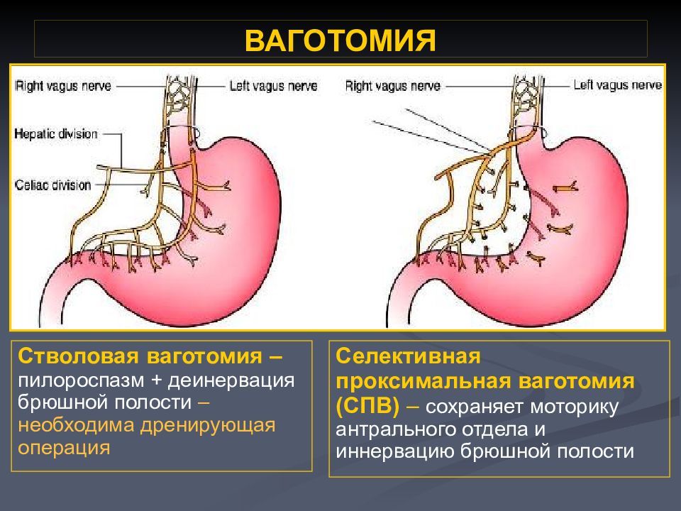 Хирургические болезни желудка. Ваготомия желудка проксимальная. Ваготомия с дренирующими желудок операциями. Ваготомия при язвенной болезни. Ваготомия желудка при язвенной болезни.