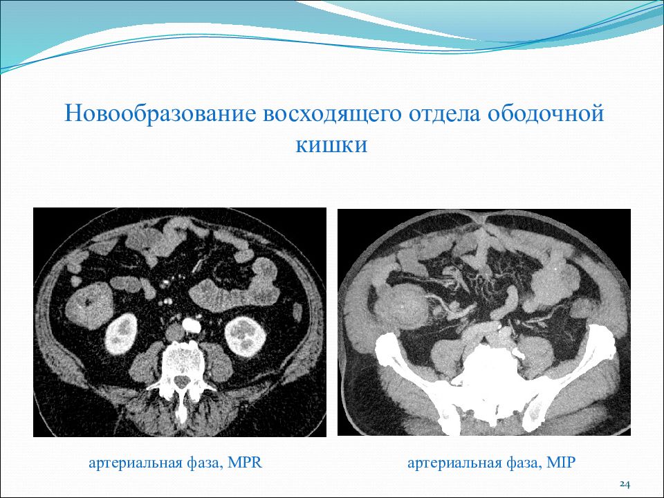 Mip изображение кт