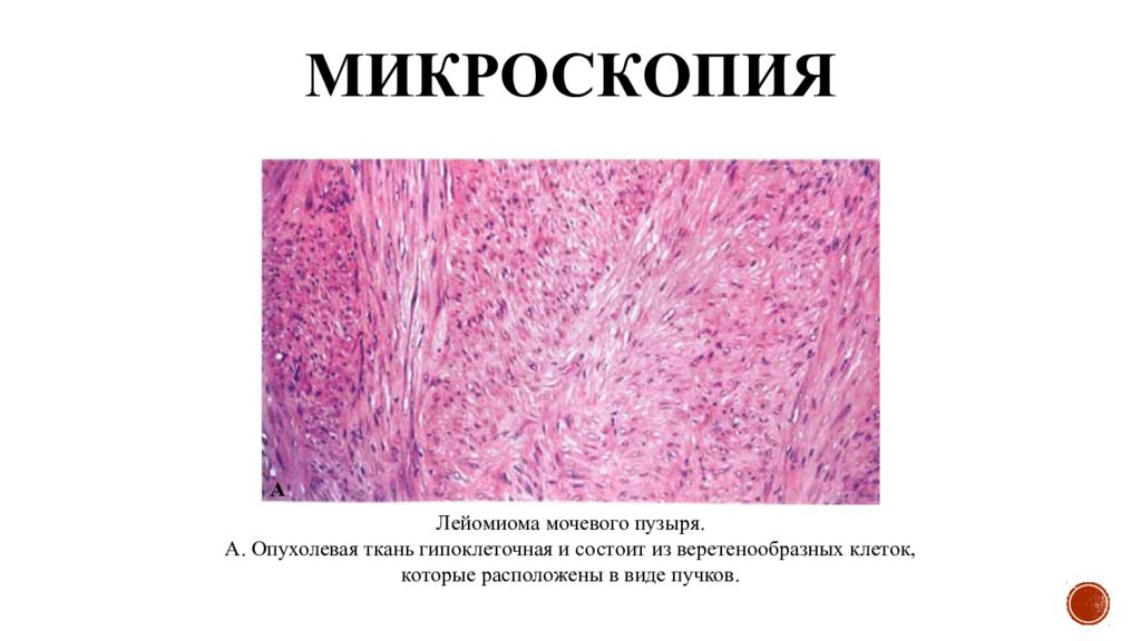 Фиброма пищевода микропрепарат рисунок