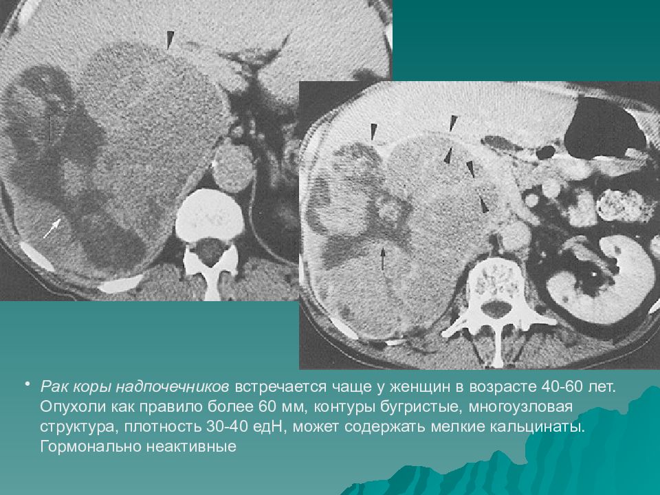 Опухоли надпочечников презентация